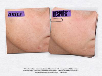 Como quitar las espinillas