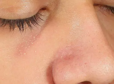 Eczema por estres 